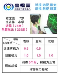 摘镜明星：近视75度，散光225度